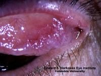 Multinodular squamous cell carcinoma arising from the superior palpebral conjunctiva and its close-up view.